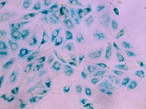 Senescent breast cancer cells