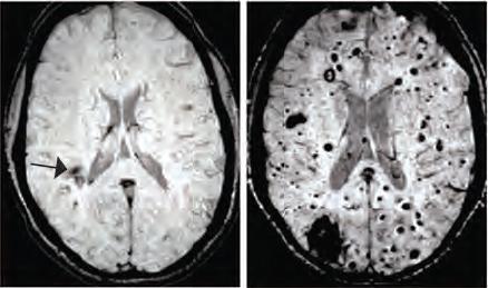CCM Lesions in the Human Brain
