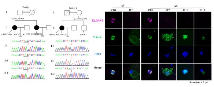 DLGAP5 mutations disrupt normal chromosome segregation and spindle formation of human oocyte meiosis and lead to female infertilit