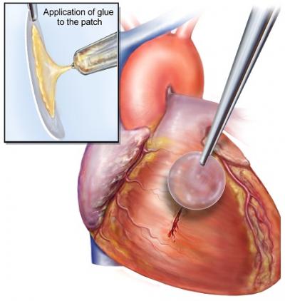 Bio-Inspired Glue Keeps Hearts Securely Sealed