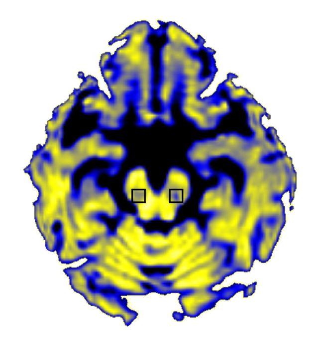 How Parkinson's Disease Alters the Brain