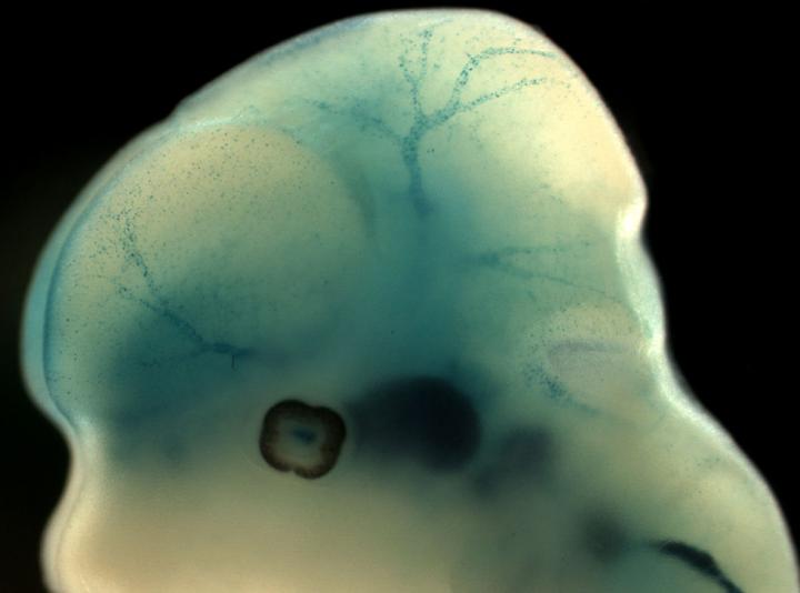 Key Protein May Affect Risk of Stroke