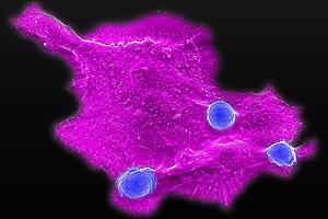 CAR-NKT cells attacking human solid tumor cell