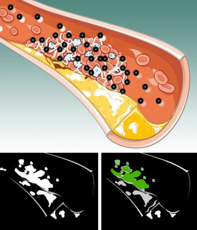 Imaging a Blood Clot