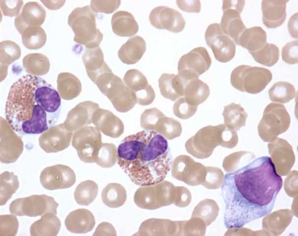 Activated Eosinophils