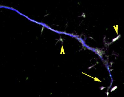 STAT3 Prevents Neurodegeneration