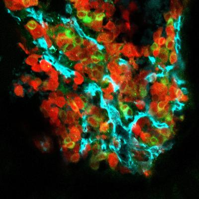 Bone Metastasis