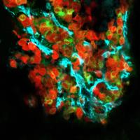 Bone Metastasis