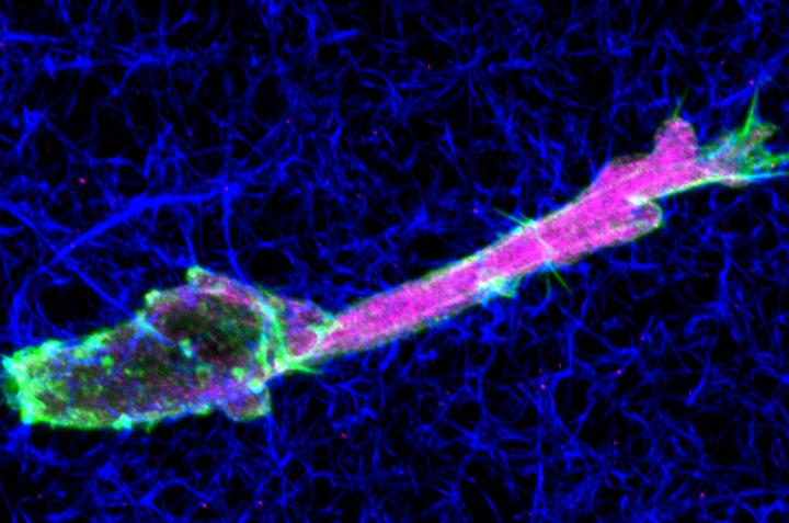 Tumor Cells Moving through Collagen
