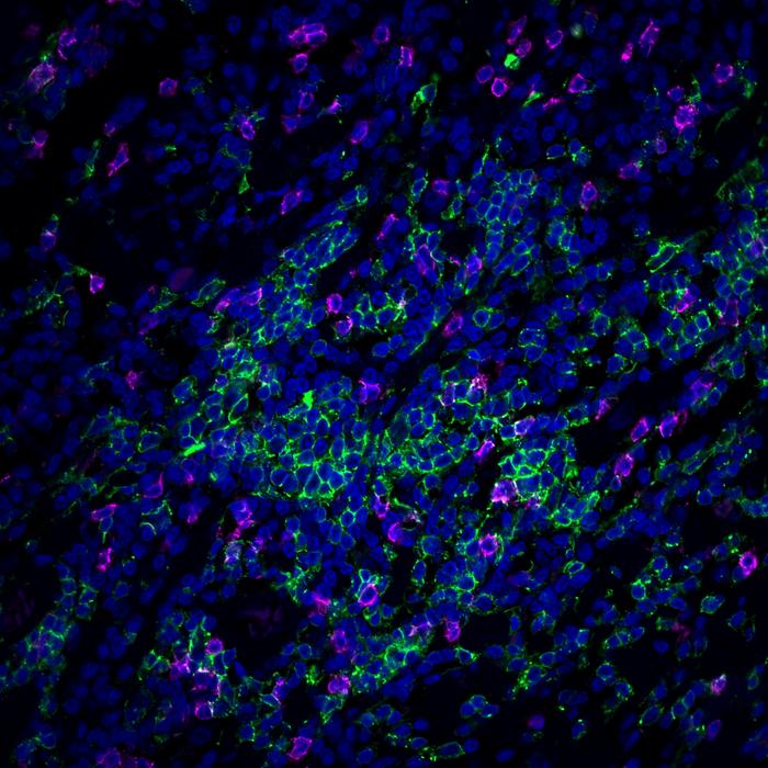 Breast cancer B cells and T cells