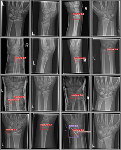 Artificial Intelligence Detection of Wrist Fractures