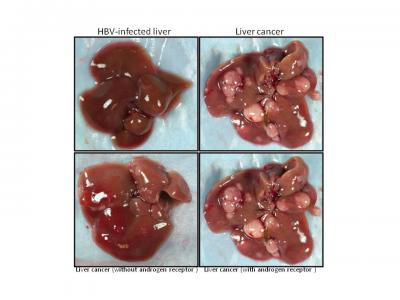 Double the Danger for Males: Hepatitis B and Liver Cancer (2 of 2)