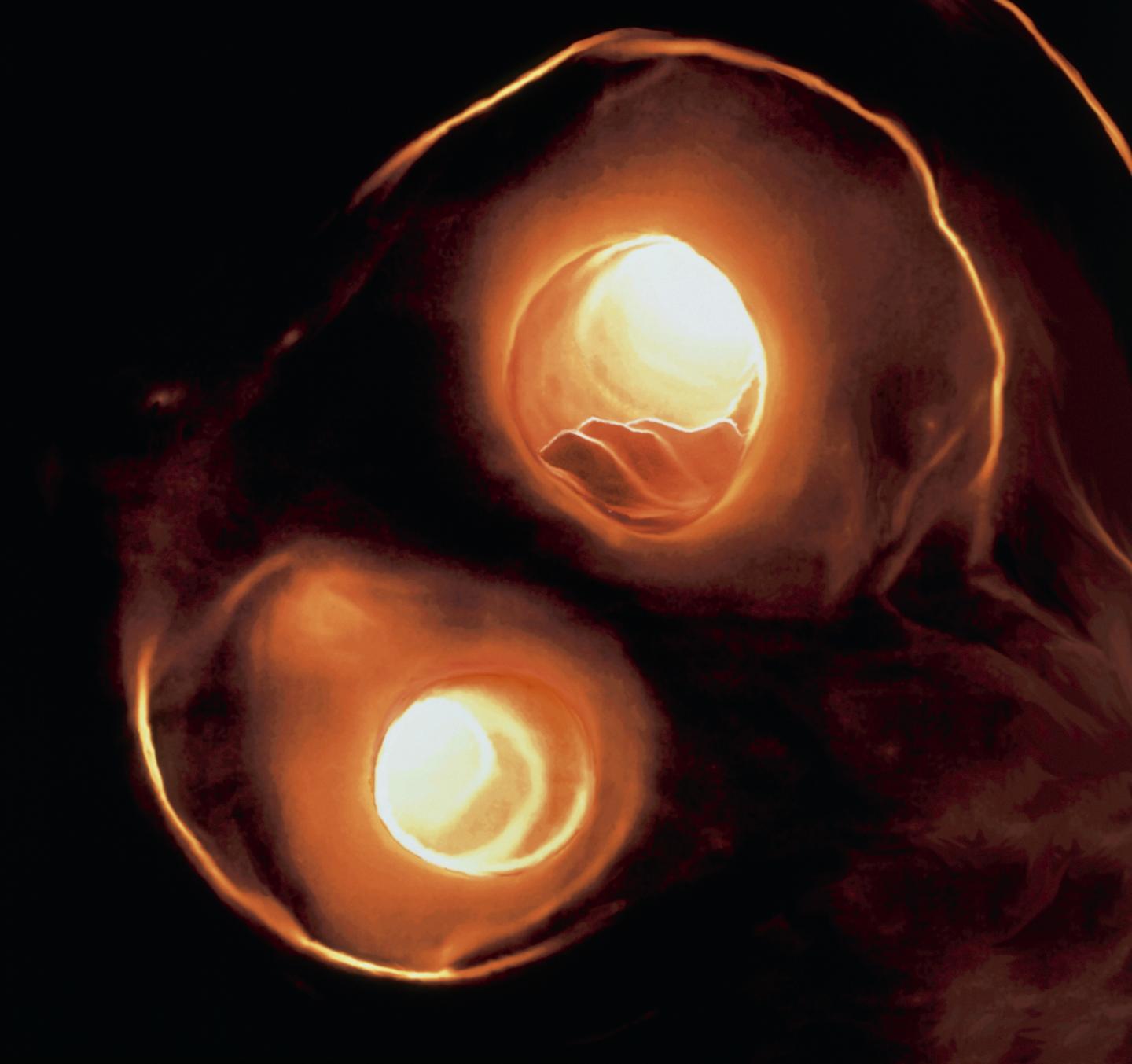 Atherosclerosis in Carotid Artery