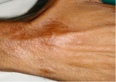 Lesions After Heat Therapy