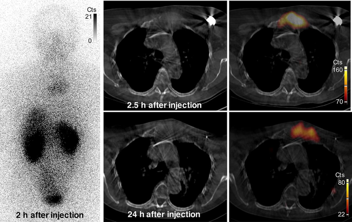 Uptake in bone metastasis.