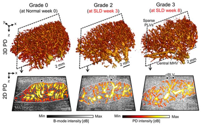 Ultrafast Ultrasound Microvascular Imaging Across Different Grades of Hepatic Steatosis