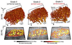 Ultrafast Ultrasound Microvascular Imaging Across Different Grades of Hepatic Steatosis