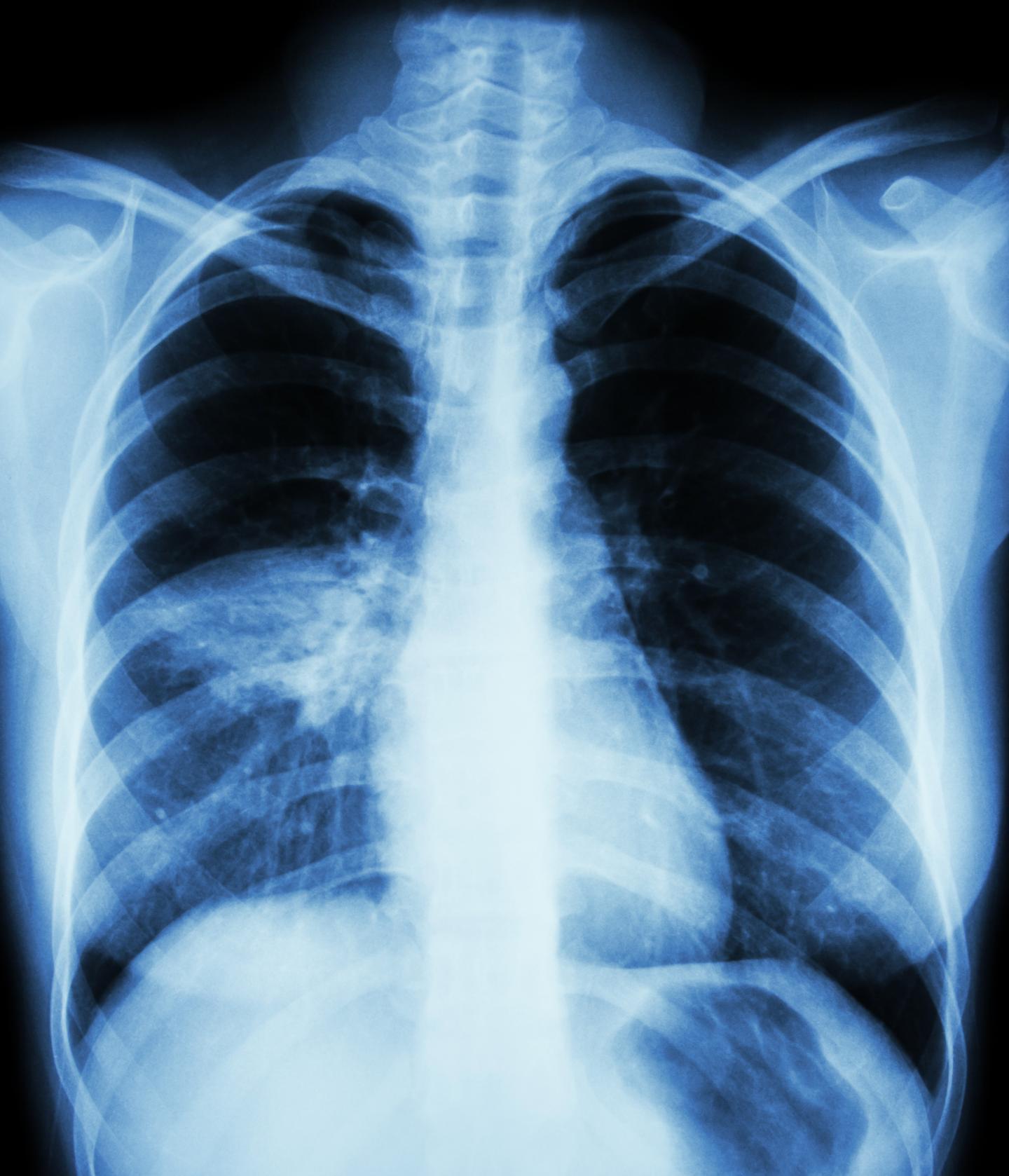 Minimizing VAP Risk.