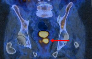Glowing prostate cancer cells PSMA PET/CT2