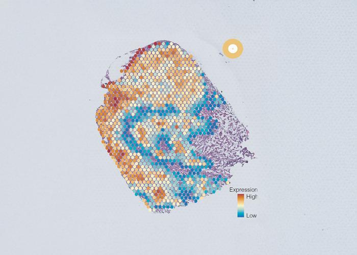 Tumour cross section showing five cell groups, each coloured differently based on gene expression.