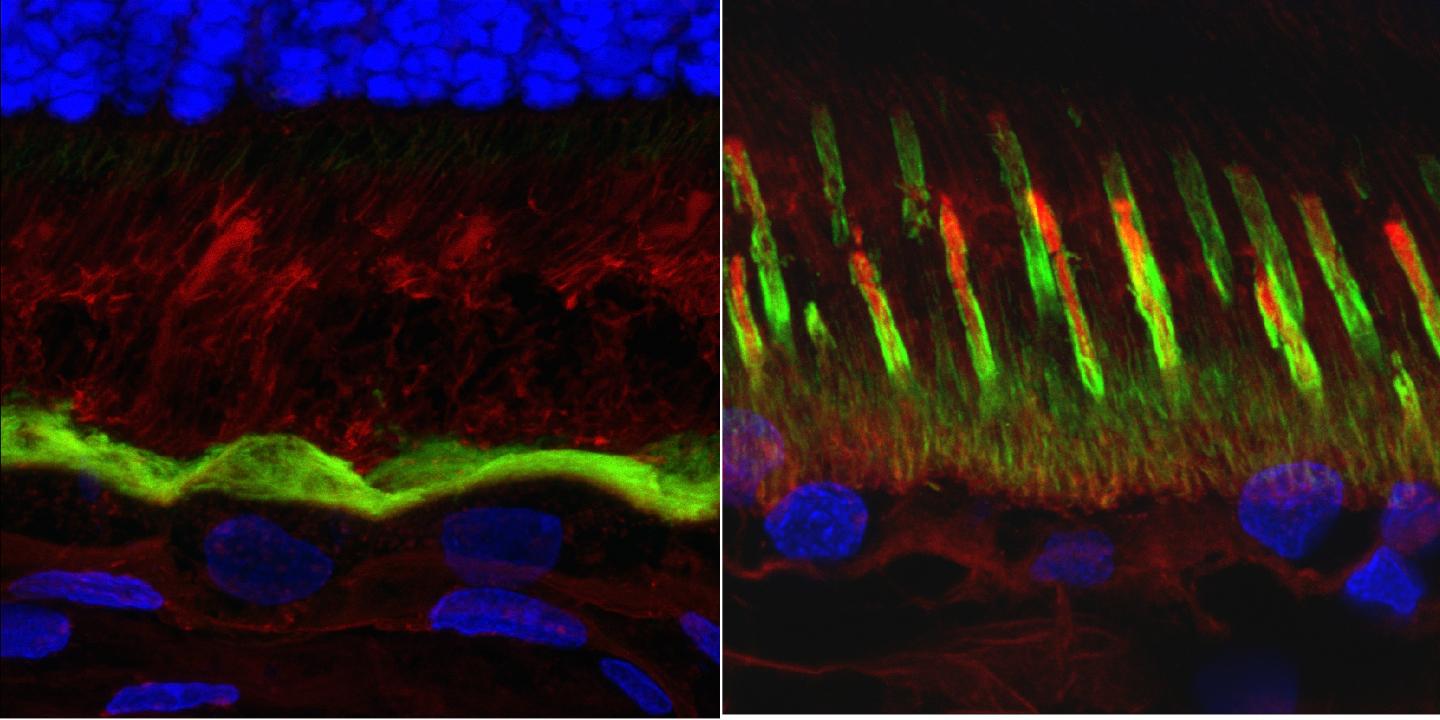 Best Disease in the Retina