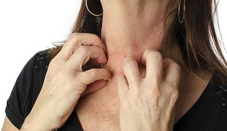 A Study Of 377,000 Sheds Light On The Role Played By The Genome In Eczema