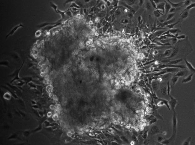 Ovarian Cancer Progression