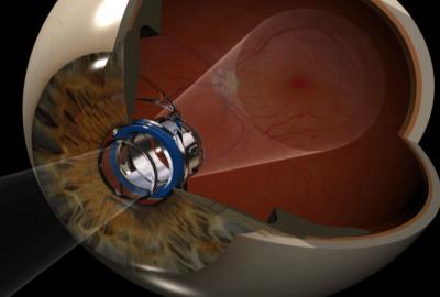 Implant Telescope for Macular Degeneration