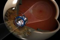 Implant Telescope for Macular Degeneration
