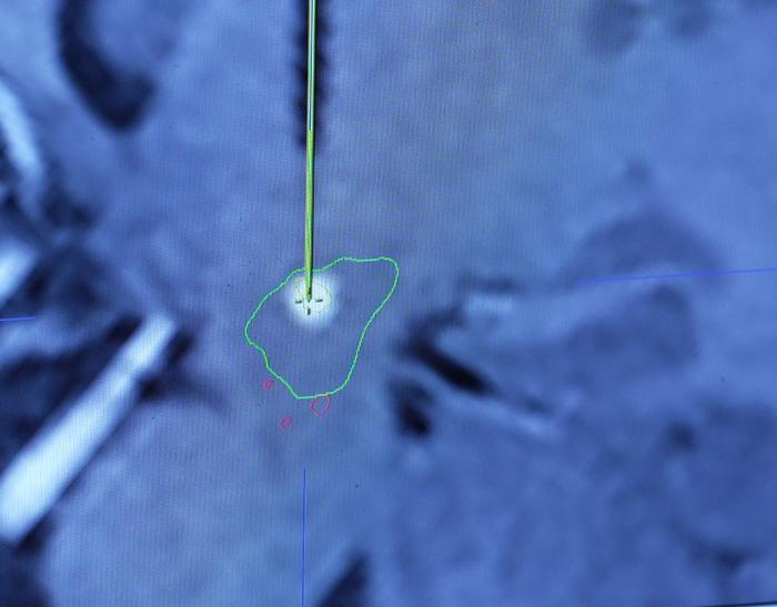 Delivery of gene therapy via novel surgical procedure along with real-time MRI (IMAGE)