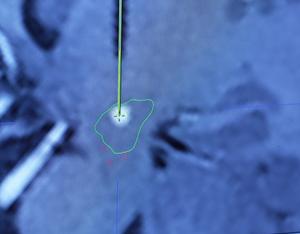 Delivery of gene therapy via novel surgical procedure along with real-time MRI (IMAGE)