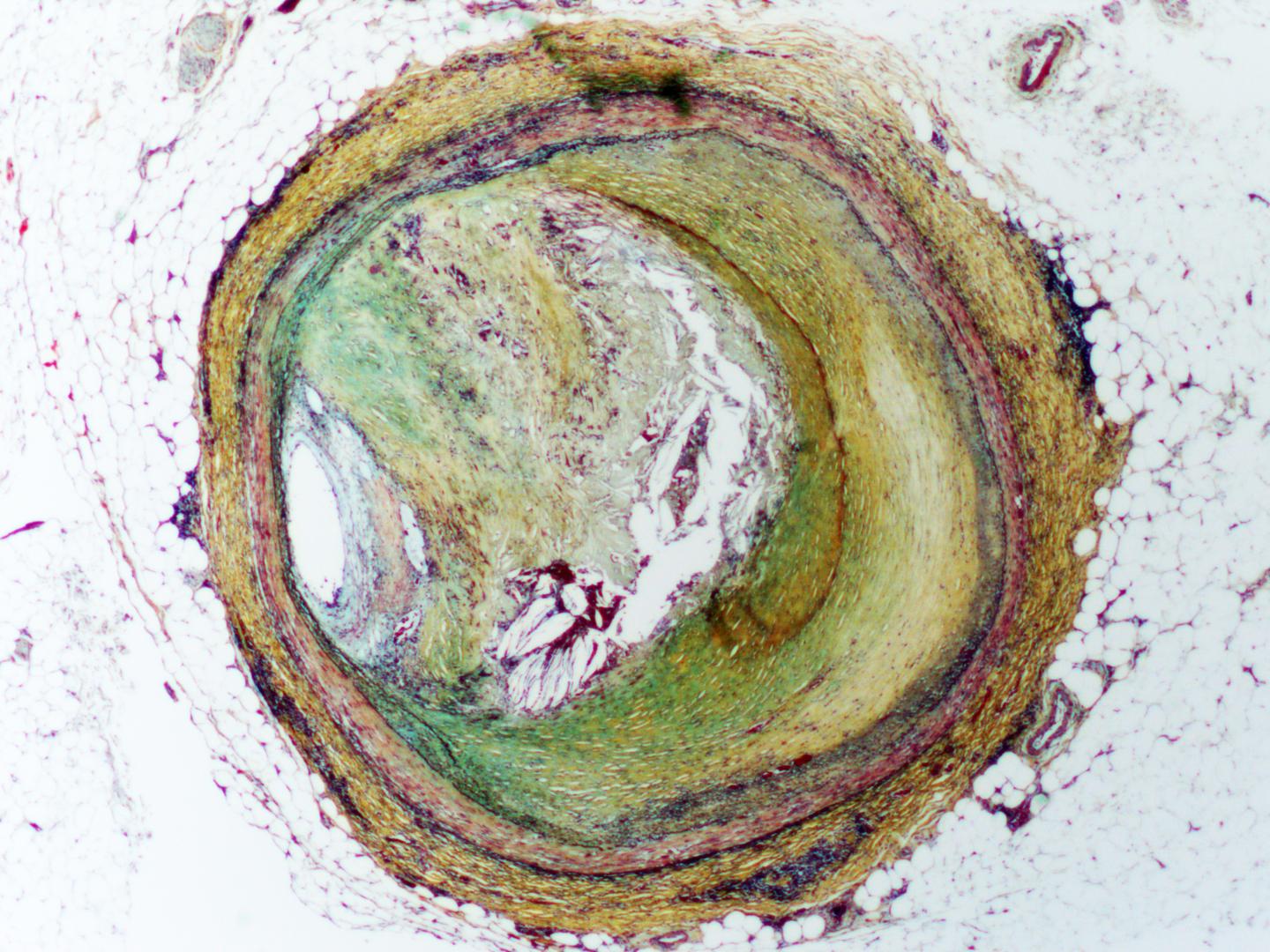 Studying Unique Kind of Cell Death Suggests New Treatments for Heart Disease (1 of 2)