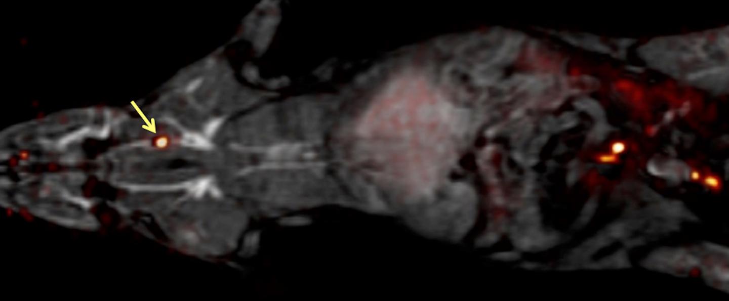 New Method Could Detect Blood Clots Anywhere in the Body with a Single Scan