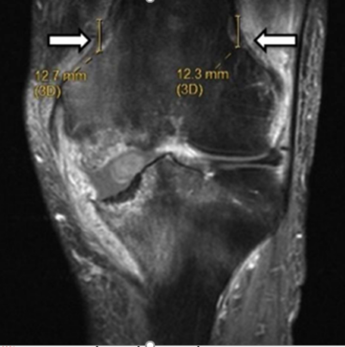 Cooled RFA Relieves Pain after Knee Replacement
