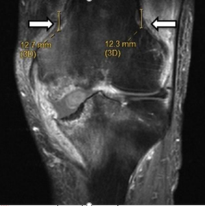 Cooled RFA Relieves Pain after Knee Replacement