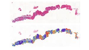 Biopsy