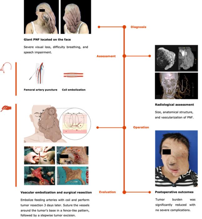 Workflow of the entire process before, during, and after surgery of a 31-year-old female with giant PNF on the left face.