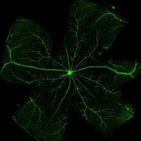 Ubretinal Hemorrhage in a Wet Macular Degeneration Patient
