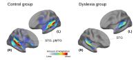 Dyslexic Brains Versus Control Group (2 of 2)