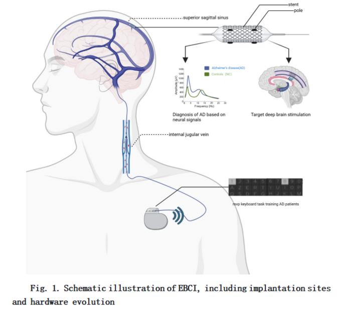 Fig. 1. Schematic illustration of EBCI, including implantation sites and hardware evolution