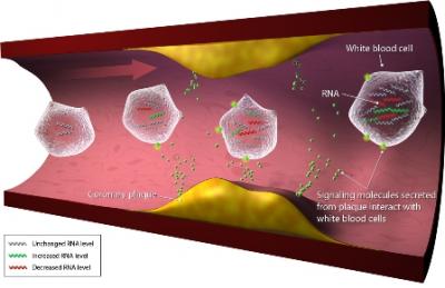 Gene Expression Test for CAD