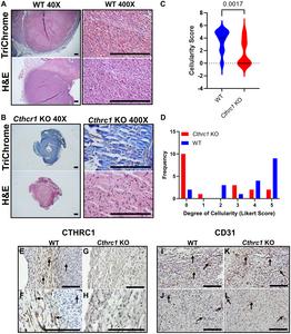 Microenvironmental CTHRC1 has a pro-tumorigenic role in colorectal cancer