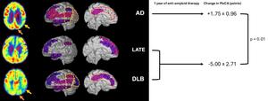 PET Imaging Links Brain Metabolism Patterns to Effectiveness of Alzheimer's Disease Treatment