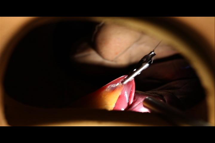 Magnetic Retractor Demo