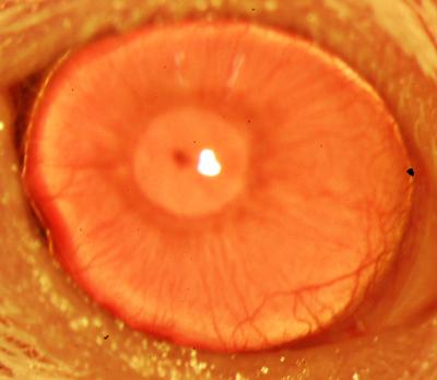 A Restored Functional Cornea
