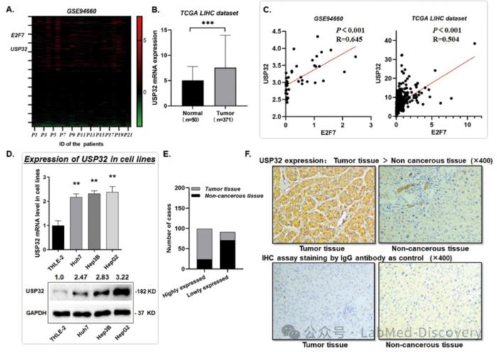 Expression profile of USP32 in hepatocellular carcinoma