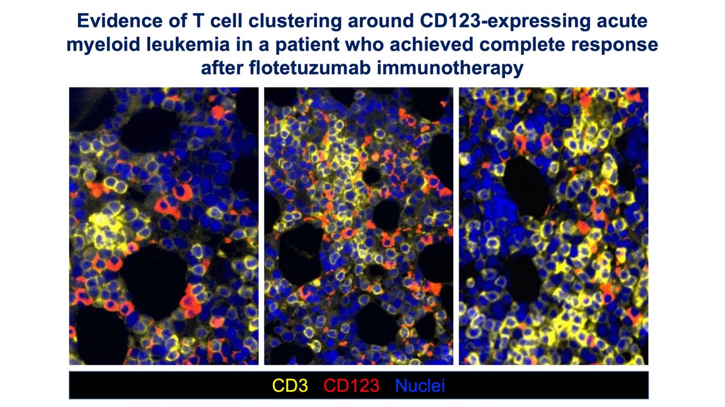 Leukemia Immune Profiles Predict Drug Resistance and Benefits of Immunotherapy (3 of 5)
