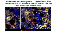 Leukemia Immune Profiles Predict Drug Resistance and Benefits of Immunotherapy (3 of 5)
