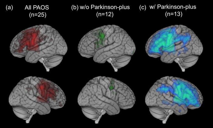 Regions where PAOS had greater neuroinflammation than controls.