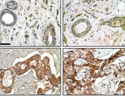 FAM83A Protein and Breast Cancer
